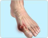 Bunion Surgery